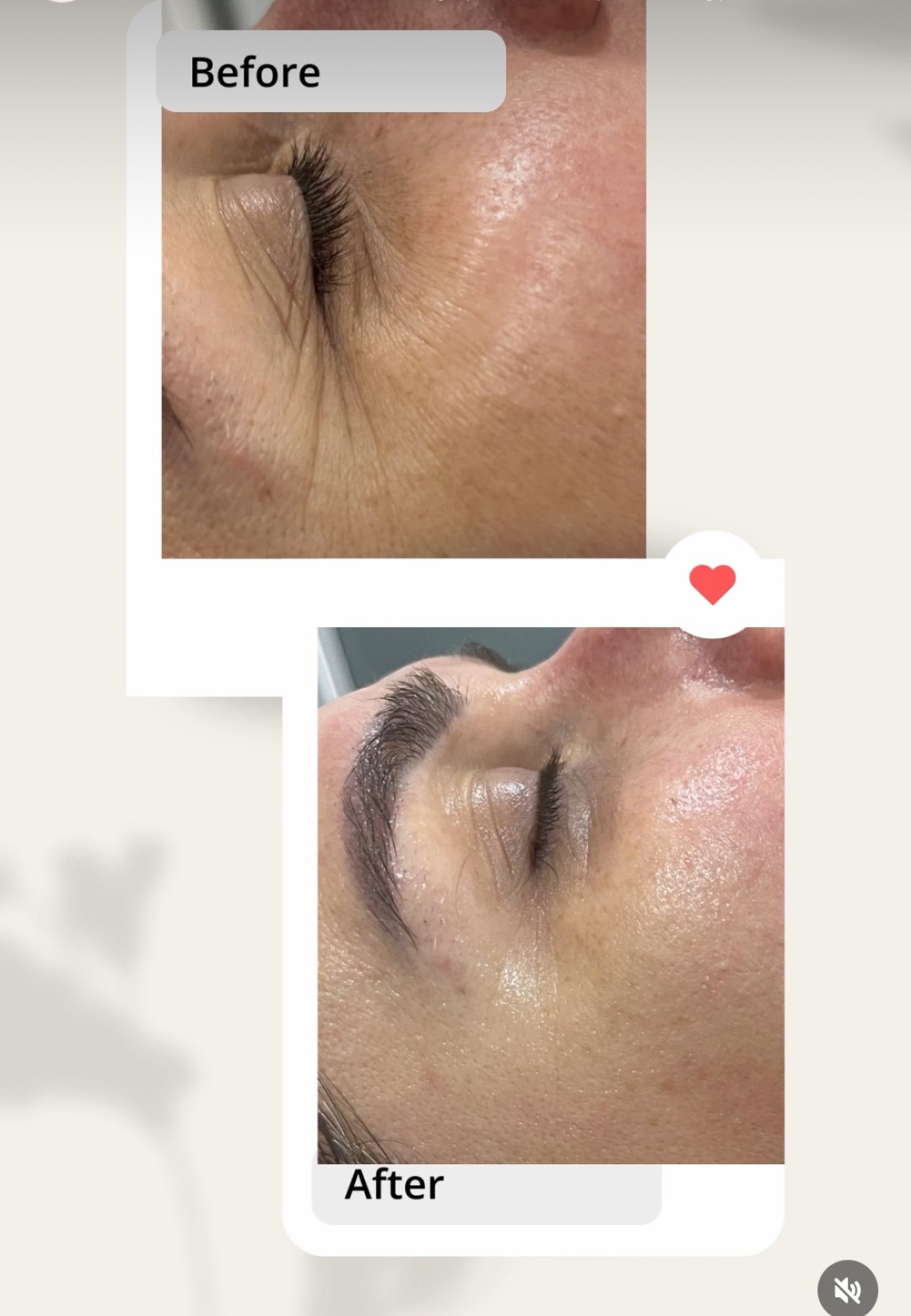 VelaShape #sarajevo Tretman lica Botox maska