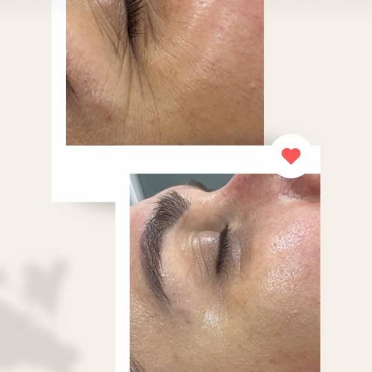 VelaShape #sarajevo Tretman lica Botox maska V-Tox No Botox maska brenda Krx Aesthetics djeluje kao 