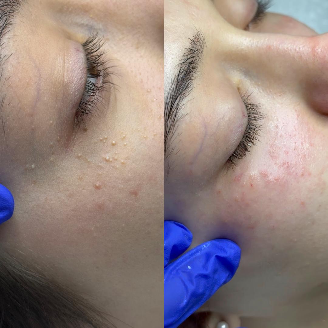 Hanas Skin Centar #banjaluka Air brush potamnjivanje kože Klasično higijensko čišćenje lica