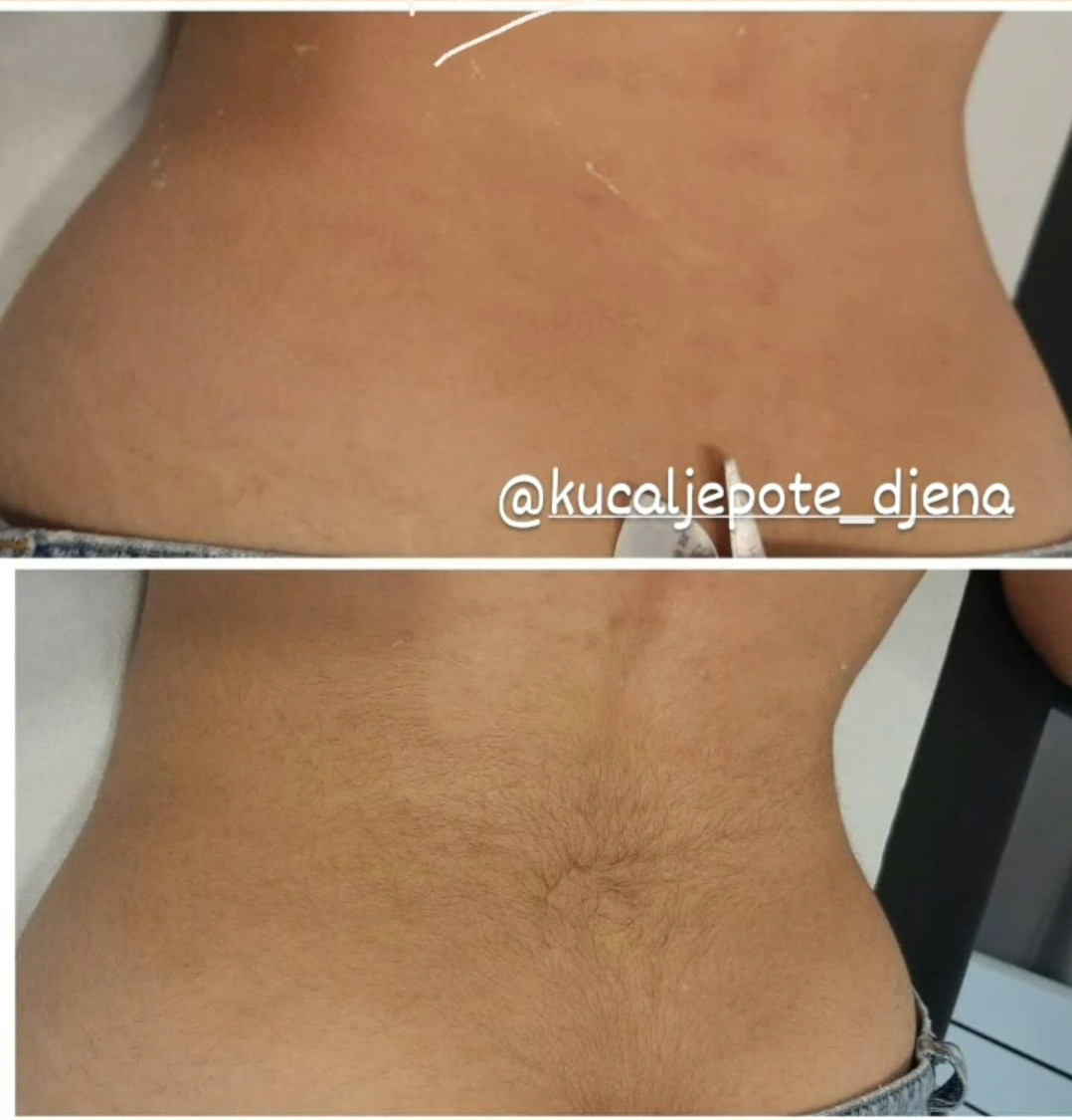 Kuća ljepote Djenna #sarajevo Depilacija šećernom pastom Depilacija leđa šećernom pastom