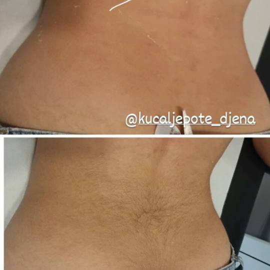 Kuća ljepote Djenna #sarajevo Depilacija šećernom pastom Depilacija leđa šećernom pastom Depil