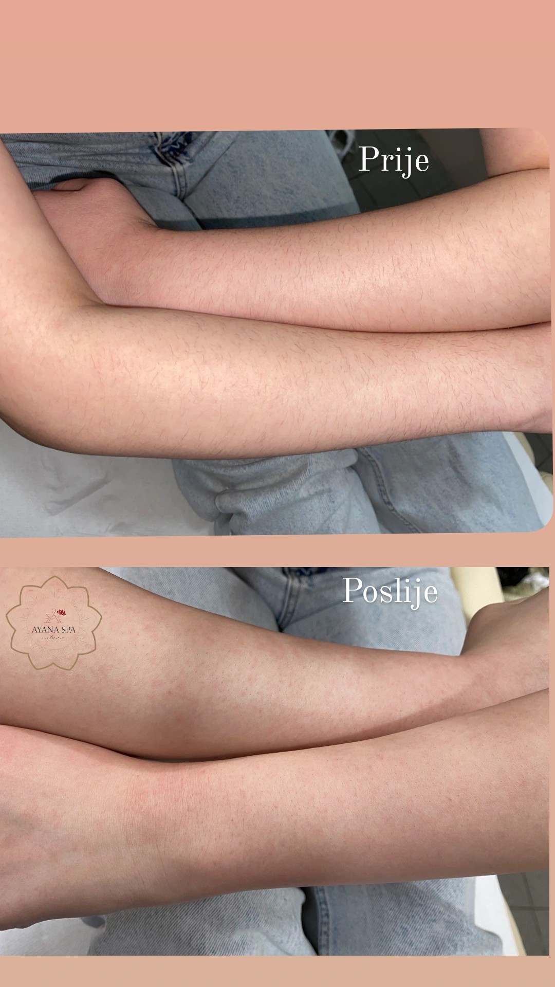 Ayana Spa #sarajevo Depilacija šećernom pastom Depilacija pola ruku šećernom pastom - za dame