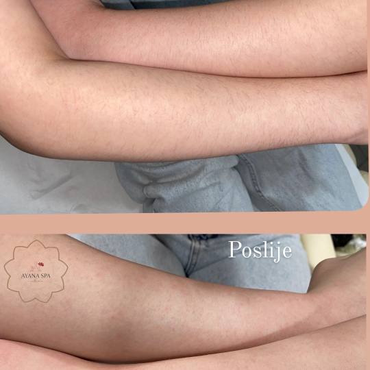 Ayana Spa #sarajevo Depilacija šećernom pastom Depilacija pola ruku šećernom pastom - za dame