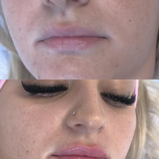 Estetika Janković #banjaluka Tretman lica Hijaluronski filer - 1 ml Korekcija usana hijaluronom