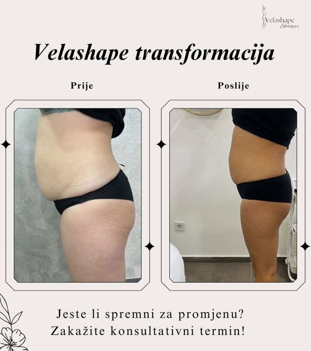 VelaShape #sarajevo Air brush potamnjivanje kože Velashape + RF tretman - stomak