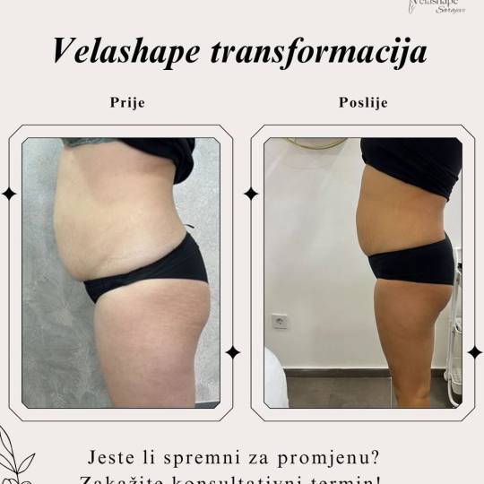VelaShape usluga