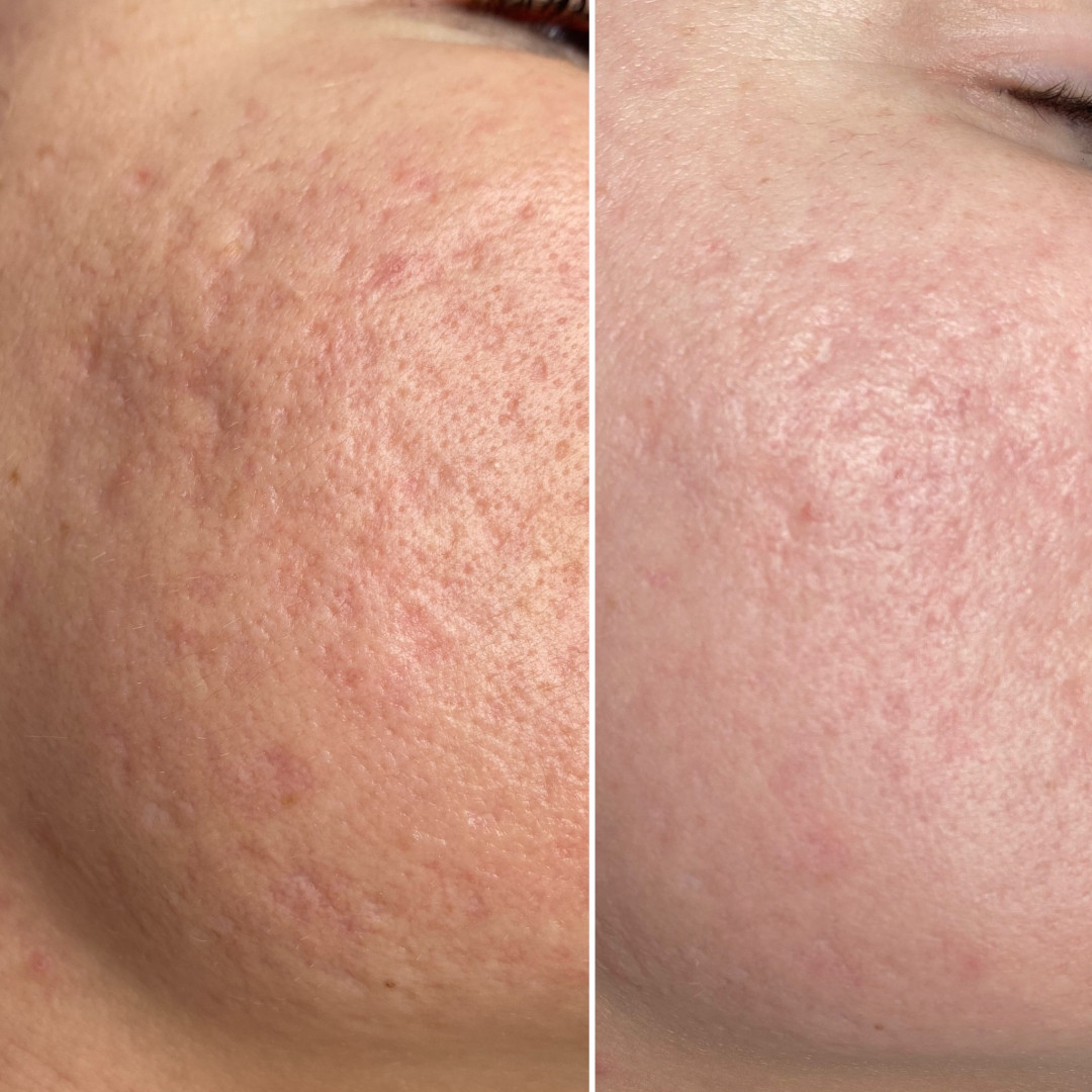 Paket tretmana za ožiljke od akni - Fabrika ljepote, Sarajevo Tretmani tijela Tijelo Tretmani tijela, Sarajevo, Istočno Sarajevo