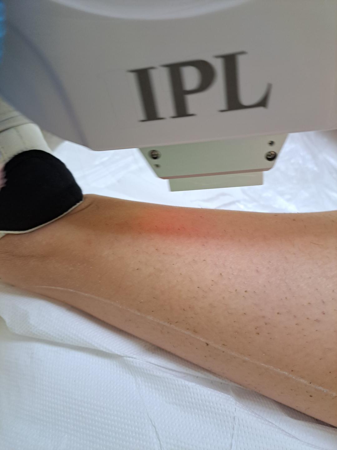 La Piel #mostar Laserska epilacija Epilacija cijelih nogu IPL aparatom - za dame