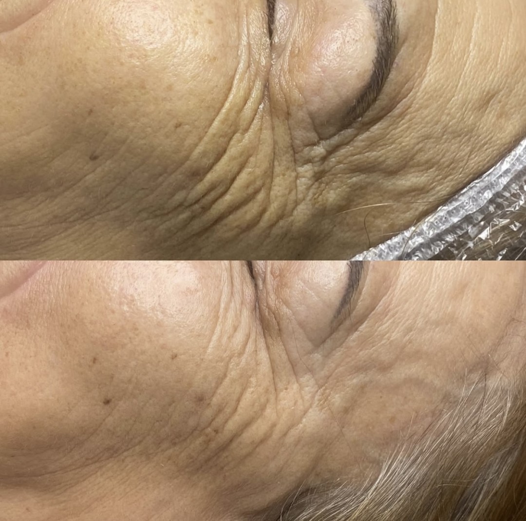 Uljepšaj se #sarajevo Tretmani protiv bora Wine theraphy / 3D antiage tretman lica