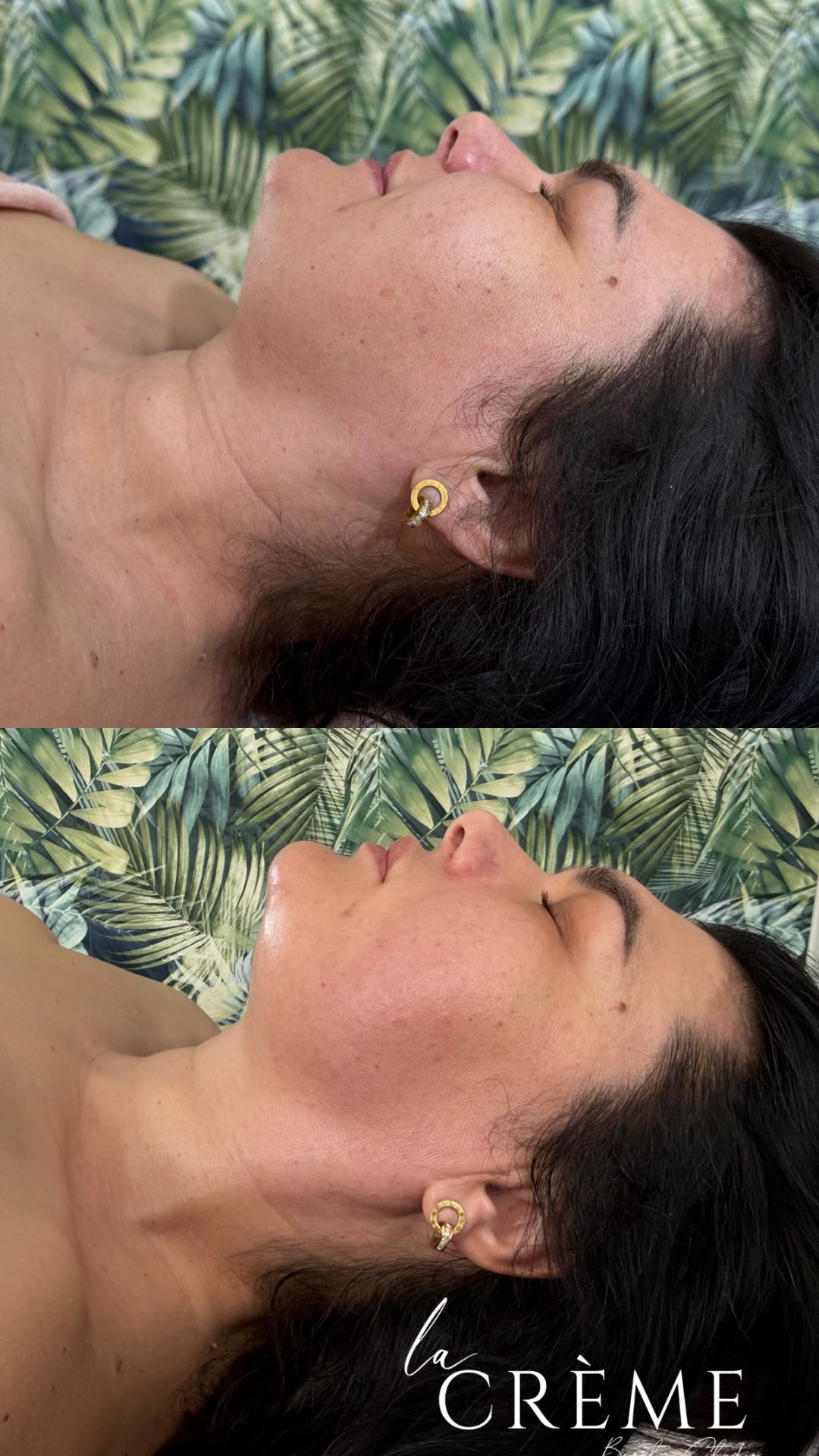 La Crème Beauty Studio #sarajevo Tretmani tijela Limfomodelovanje -Lice