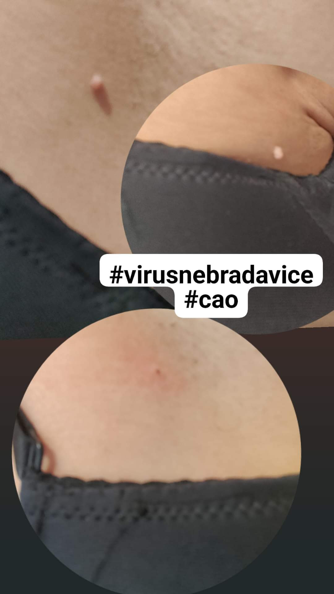 Kuća ljepote Djenna #sarajevo Medicinski pedikir Skidanje bradavica