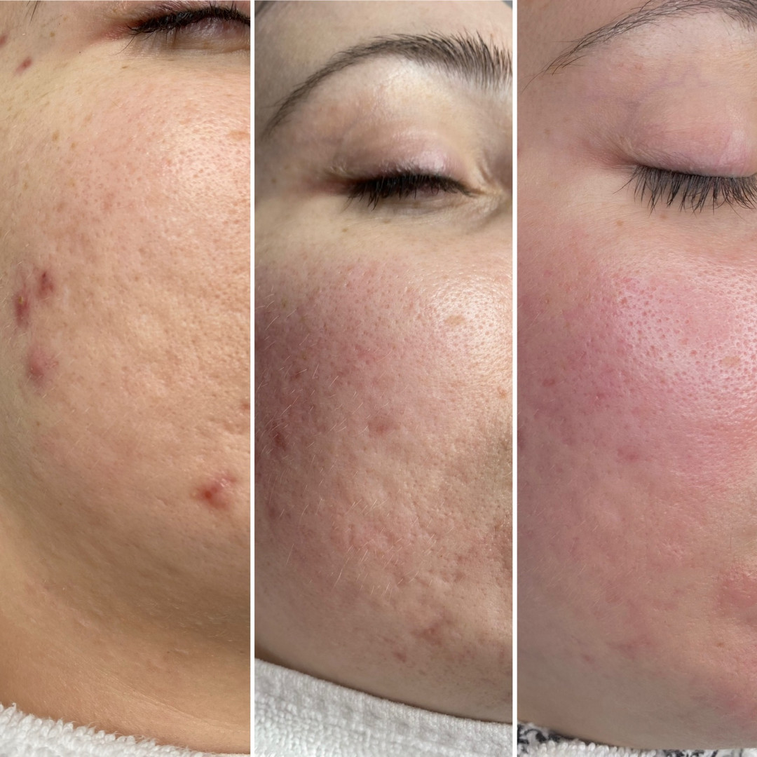 Paket tretmana za aknoznu kožu - Fabrika ljepote, Sarajevo Tretmani tijela Tijelo Tretmani tijela, Sarajevo, Istočno Sarajevo