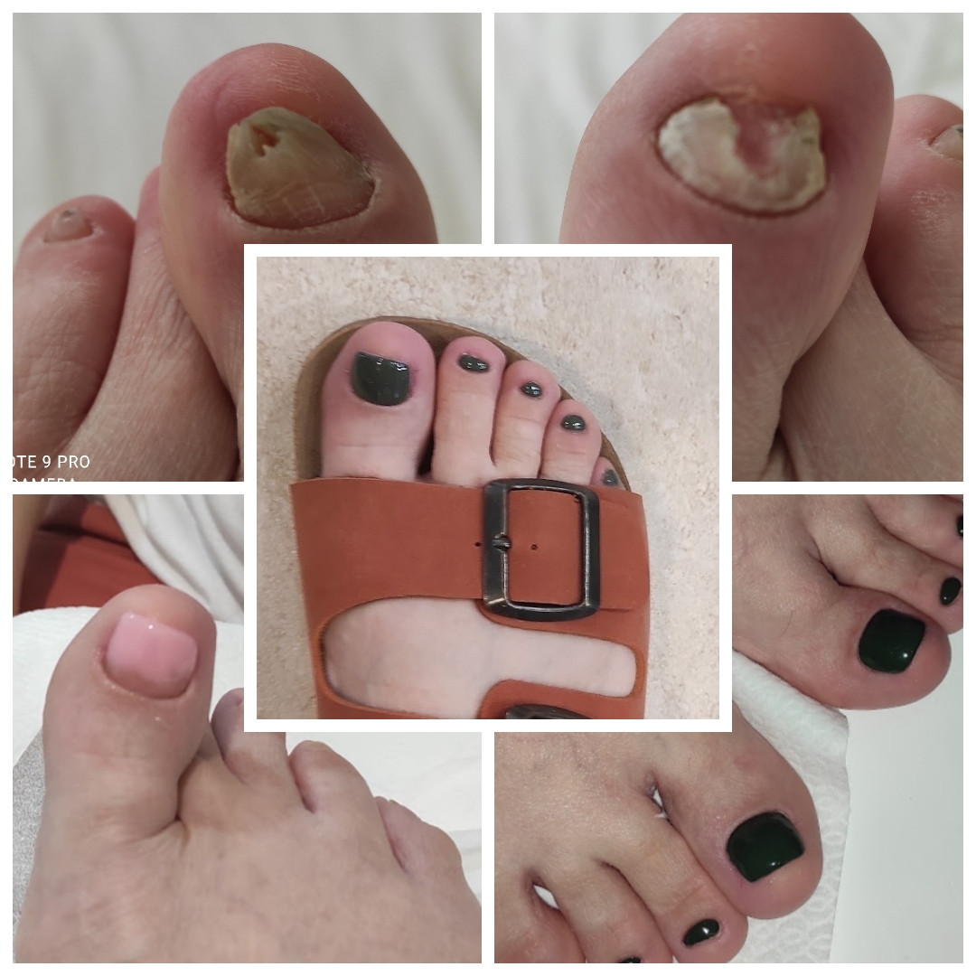 La Vie beauty centar #sarajevo Medicinski pedikir Medicinski pedikir + gel