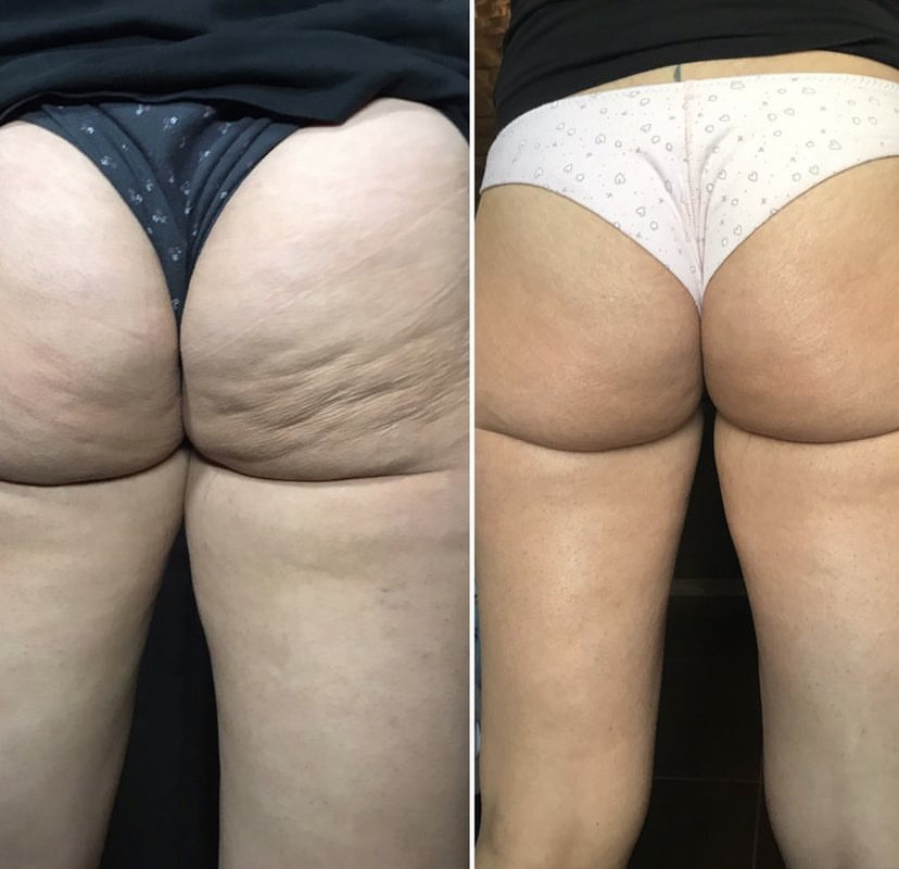 Skockica paket - maderoterapija cijelo tijelo - Fabrika ljepote, Sarajevo Anticelulit masaža Masaža Anticelulit masaža, Sarajevo, Istočno Sarajevo