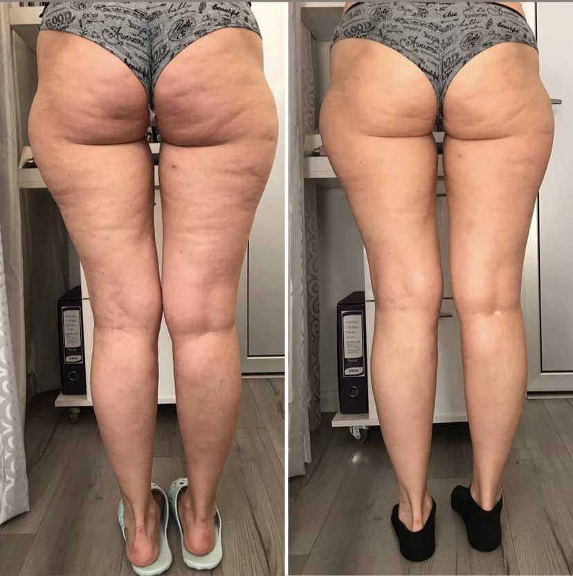 Skockica paket - maderoterapija noge + gluteus - Fabrika ljepote, Sarajevo Anticelulit masaža Masaža Anticelulit masaža, Sarajevo, Istočno Sarajevo