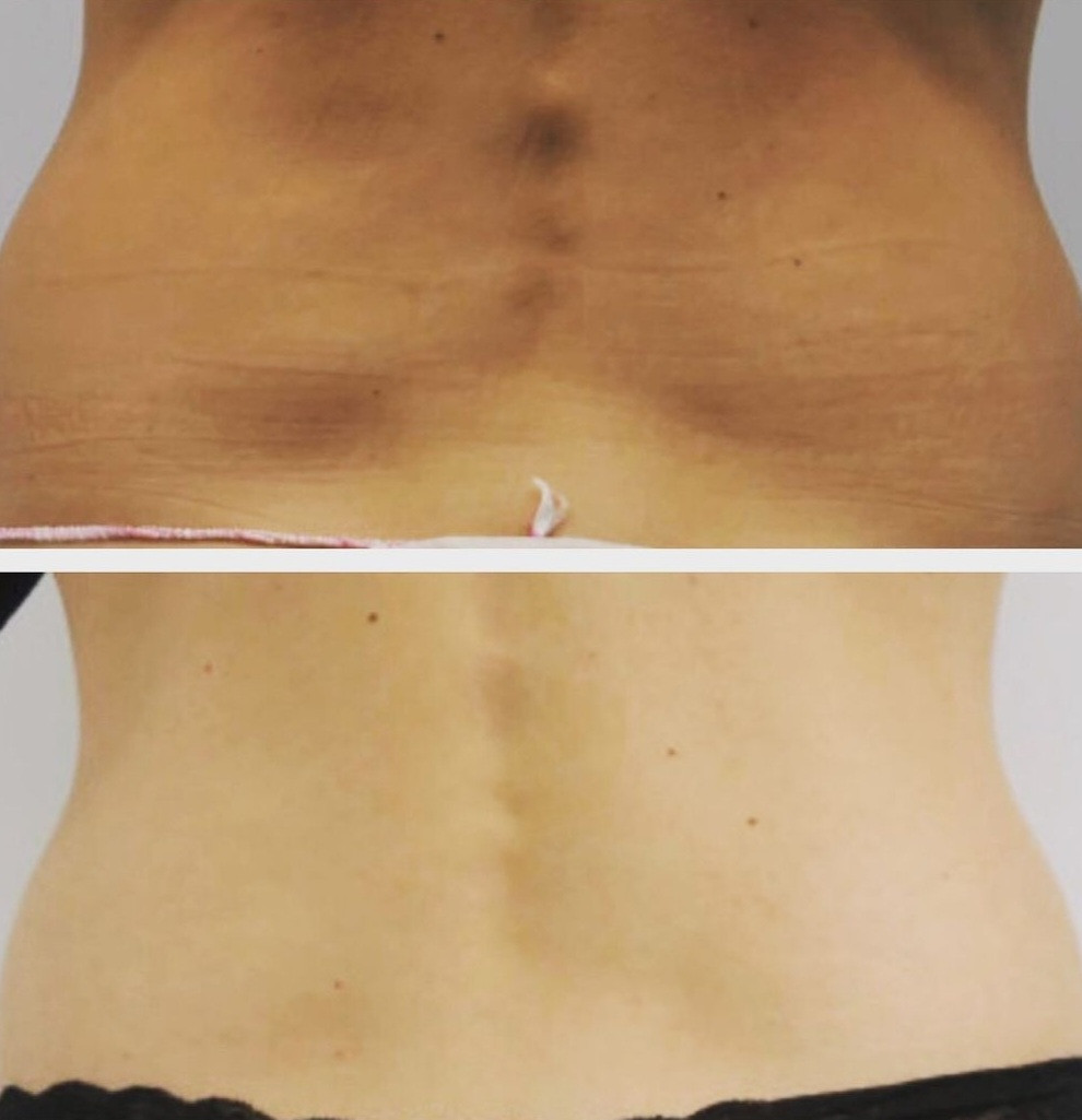 Sandra #visoko Tretmani tijela HiFU - struk