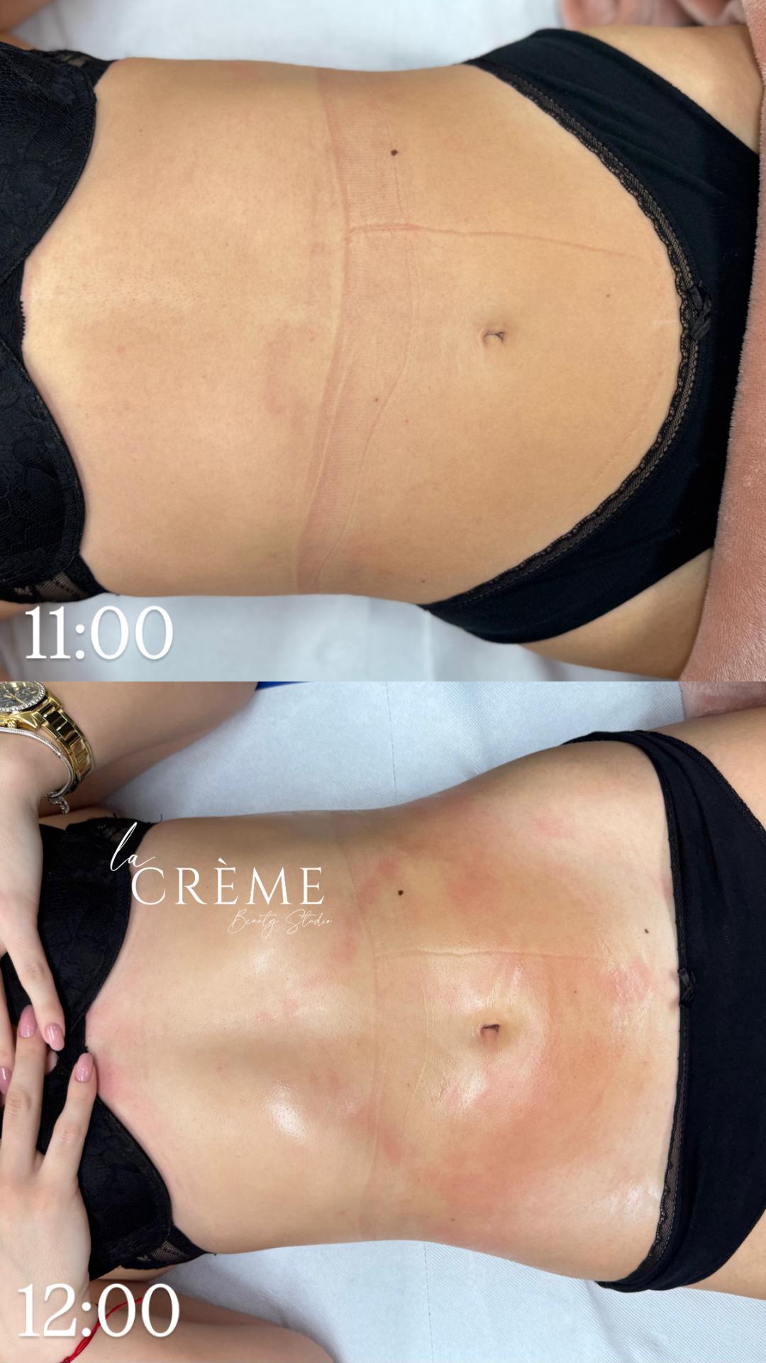 La Crème Beauty Studio #sarajevo Tretmani tijela Brazilska Limfna Drenaza - po regiji