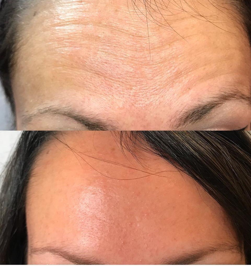 Sandra #visoko Tretman lica Biorevitalizacija lica