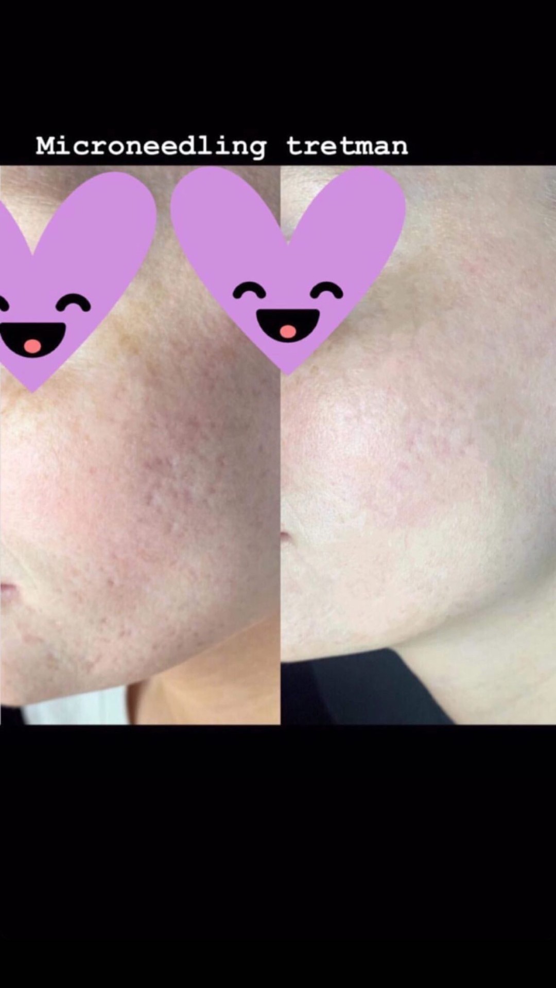 Damen #sarajevo Tretman lica Ultrazvučno čišćenje + microneedling tretman lica