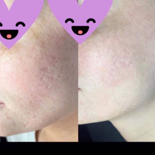 Damen #sarajevo Tretman lica Ultrazvučno čišćenje + microneedling tretman lica Uklanjanje ožilj