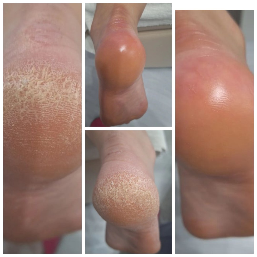 Poezija ljepote #sarajevo Estetski pedikir Ruska pedikura - bez laka