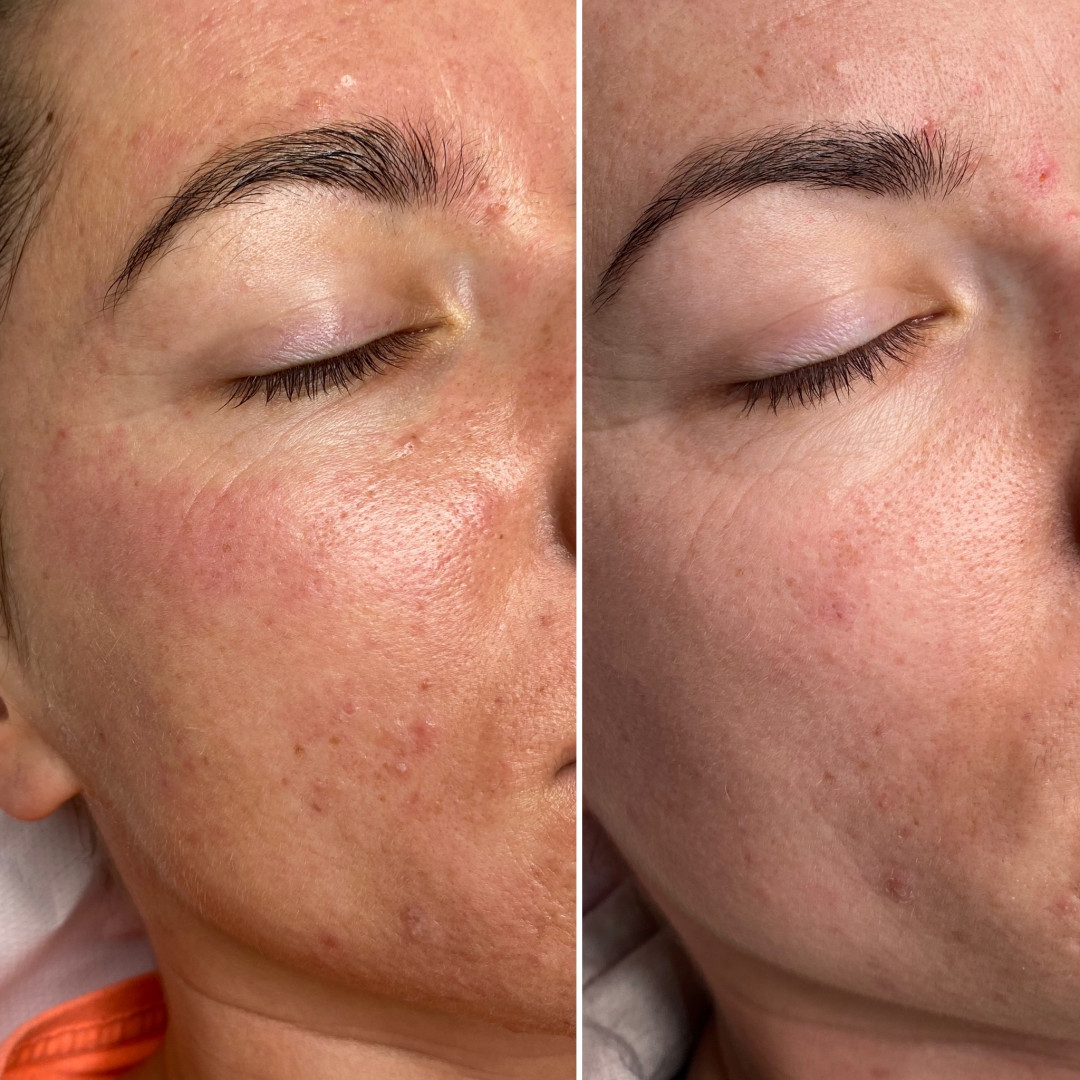 Paket tretmana za aknoznu kožu - Fabrika ljepote, Sarajevo Tretmani tijela Tijelo Tretmani tijela, Sarajevo, Istočno Sarajevo