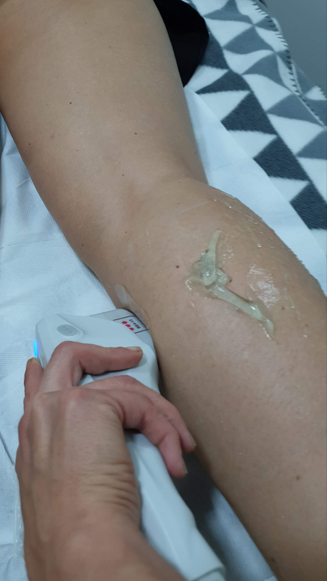 Sandra #visoko Tretmani tijela HiFU - listovi