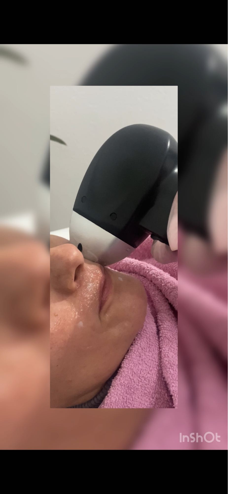 Laser Beauty Studio #visoko Laserska epilacija Laserska epilacija nausnica - za dame