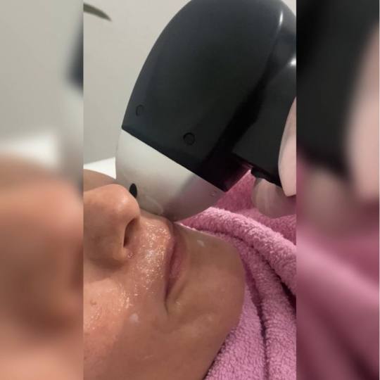 Laser Beauty Studio #visoko Laserska epilacija Laserska epilacija nausnica - za dame