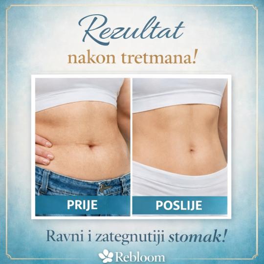 Rebloom #sarajevo Tretmani za mršavljenje Rebloom kriolipoliza - jedna regija sa dvije sonde Krioli