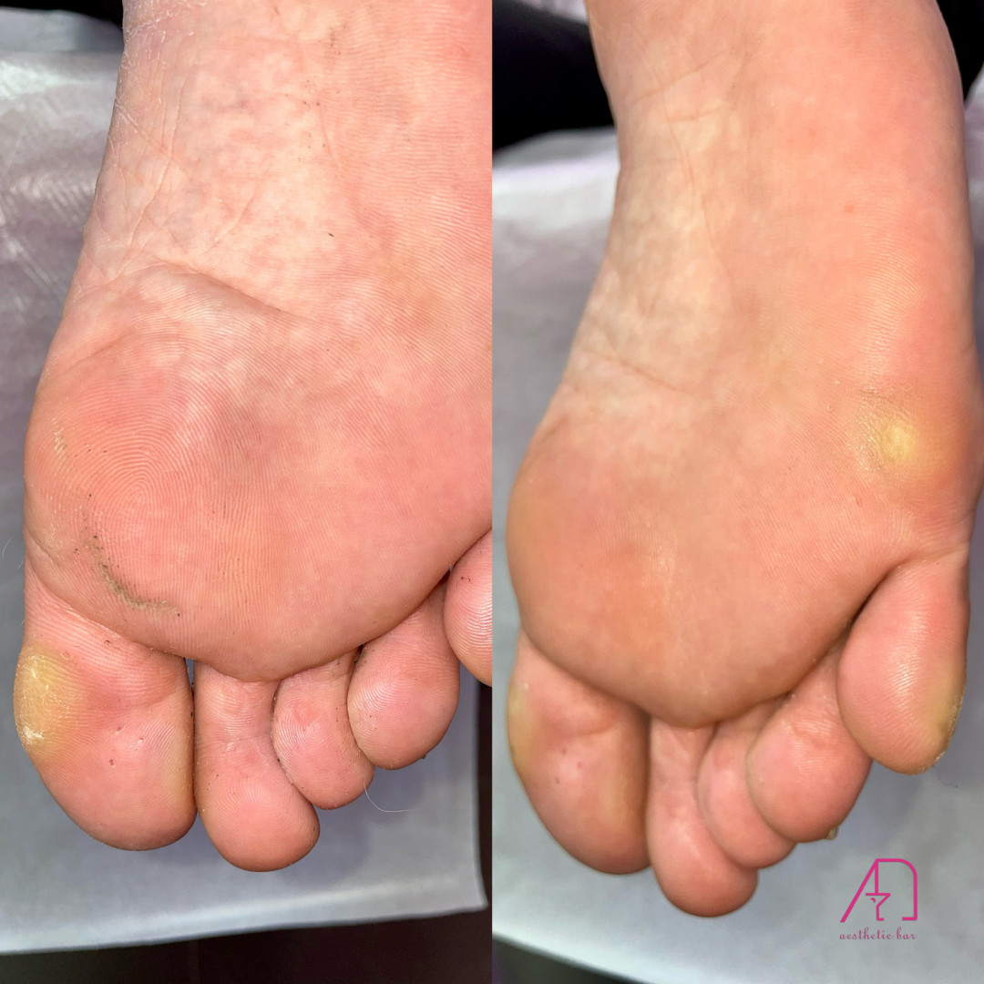 AEsthetic Bar Academy #sarajevo Estetski pedikir Ruski pedikir