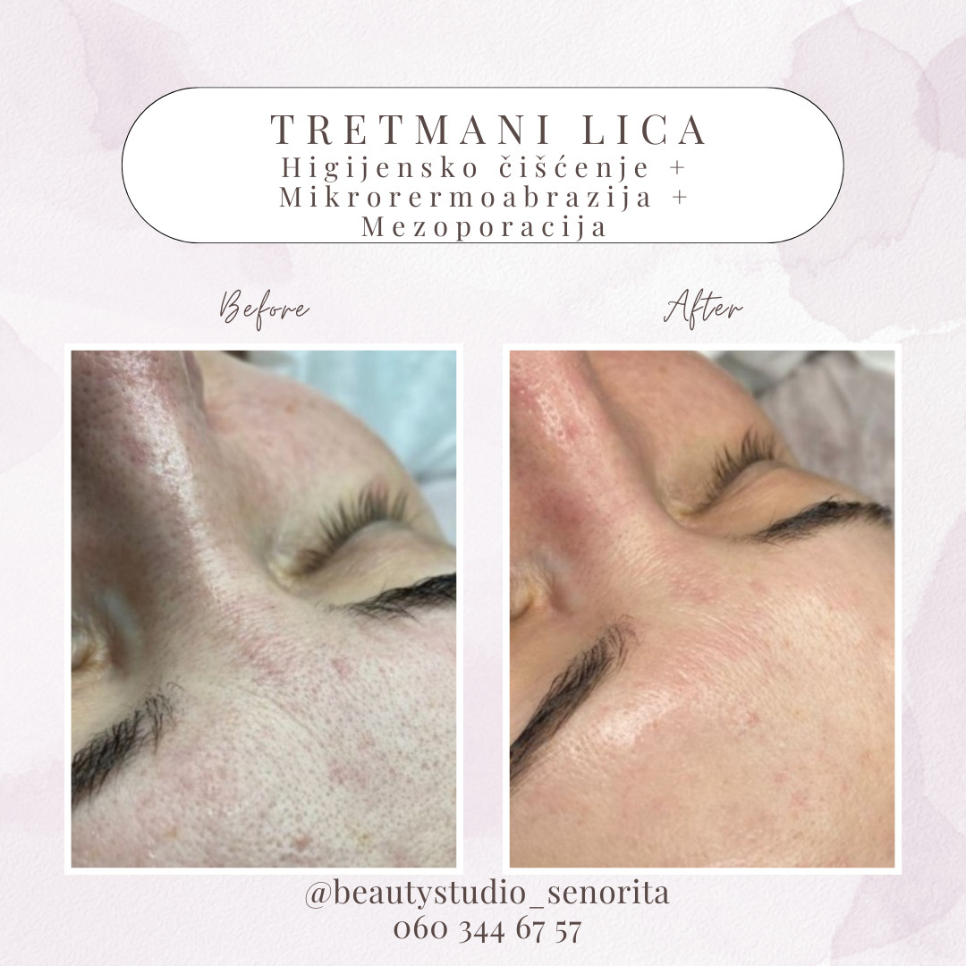 Beauty Studio Señorita #sarajevo Tretman lica Mikrodermoabrazija + Ultrazvučno hranjenje lica