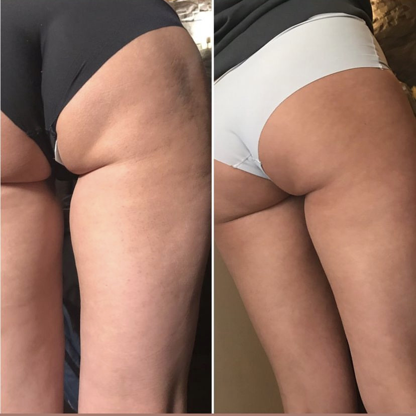 Skockica paket - maderoterapija cijelo tijelo - Fabrika ljepote, Sarajevo Anticelulit masaža Masaža Anticelulit masaža, Sarajevo, Istočno Sarajevo