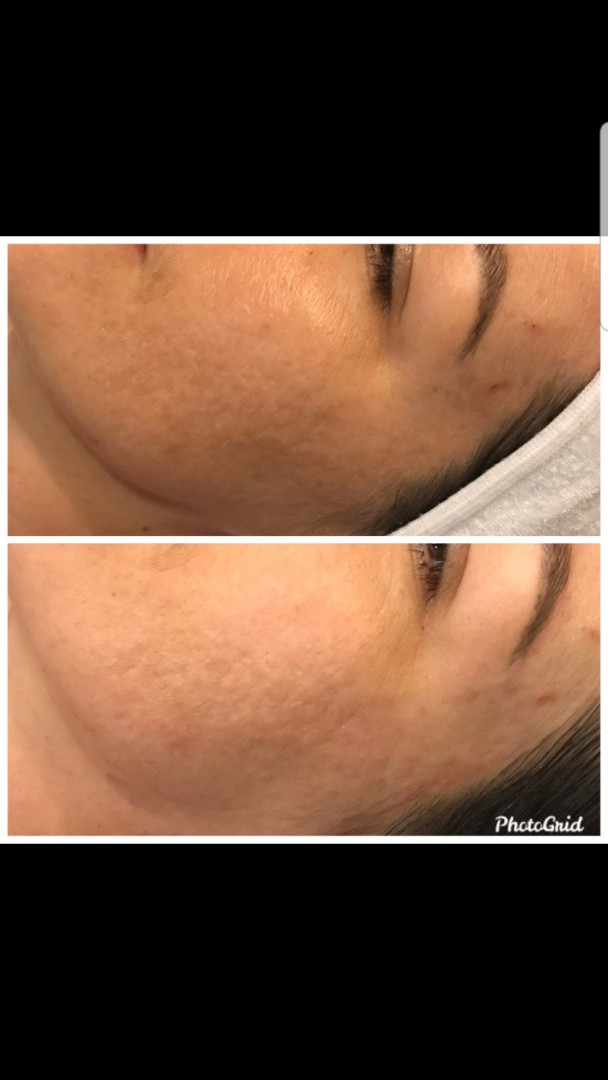 Vedrana #sarajevo Tretman lica