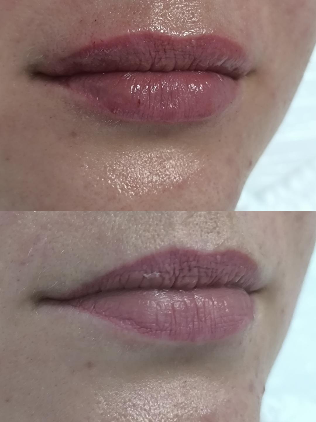 Hijaluronski filer - 1 ml - Estetika Janković, Banja Luka Tretman lica Lice Tretman lica, Banja Luka, Centar