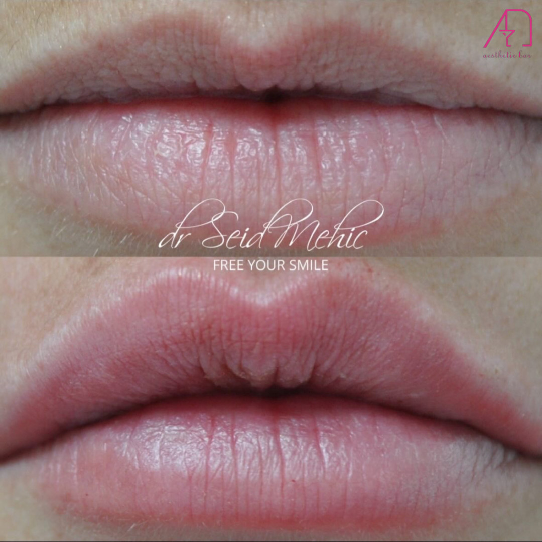 AEsthetic Bar Academy #sarajevo Hijaluronski tretmani lica