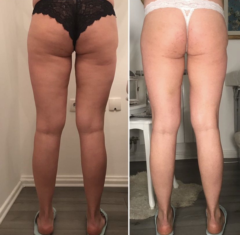 Skockica paket - maderoterapija noge + gluteus - Fabrika ljepote, Sarajevo Anticelulit masaža Masaža Anticelulit masaža, Sarajevo, Istočno Sarajevo