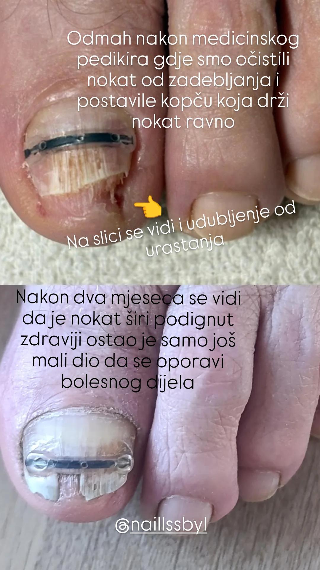 Studio Relax #kozarska-dubica Ojačavanje noktiju Medicinski pedikir sa postavkom kopče za urasli nokat