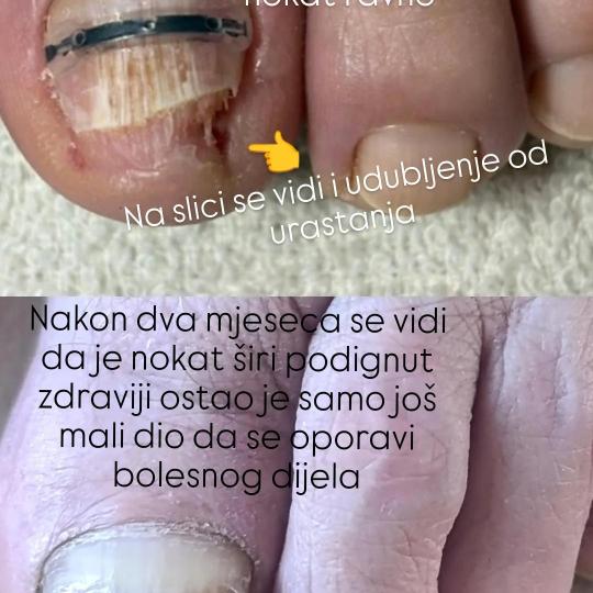 Studio Relax #kozarska-dubica Ojačavanje noktiju Medicinski pedikir sa postavkom kopče za urasli n
