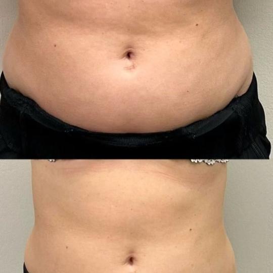Elan beauty by Amra #sarajevo Tretmani tijela Kriolipoliza masnih naslaga - abdomena Kriolipoliza il