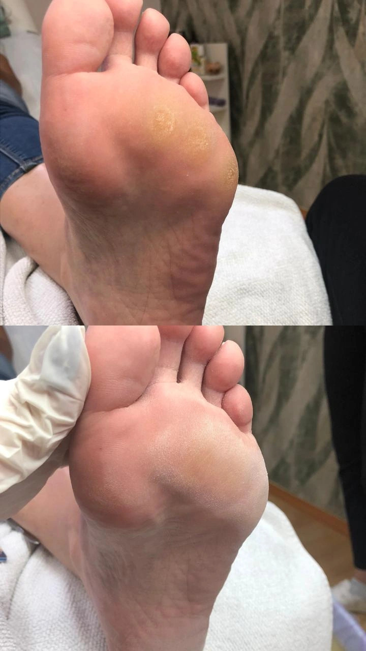 Krasyva #sarajevo Estetski pedikir Klasična pedikura