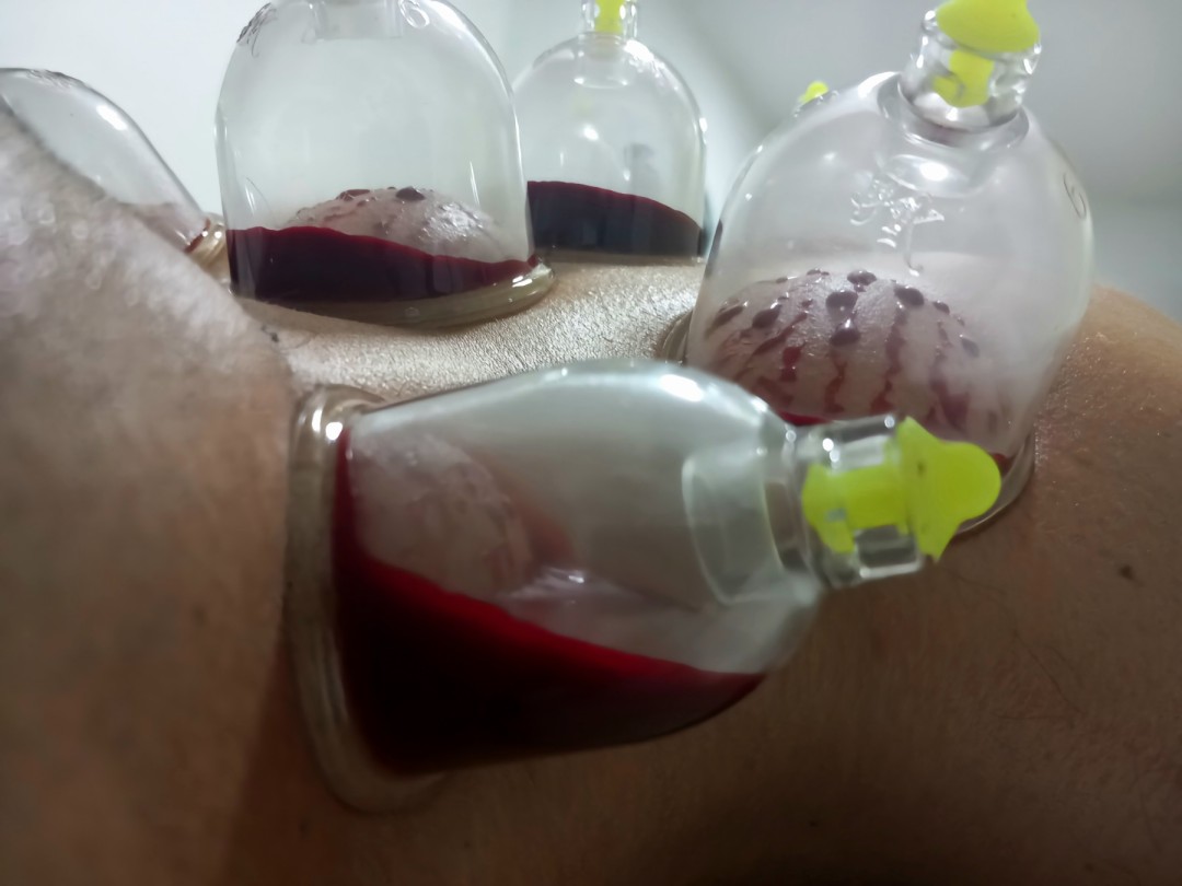 Magic #sarajevo Tretmani tijela Hidžama - leđa