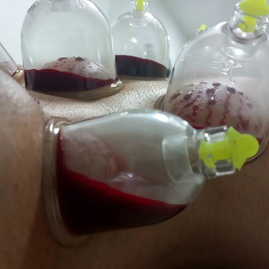 Magic #sarajevo Tretmani tijela Hidžama - leđa