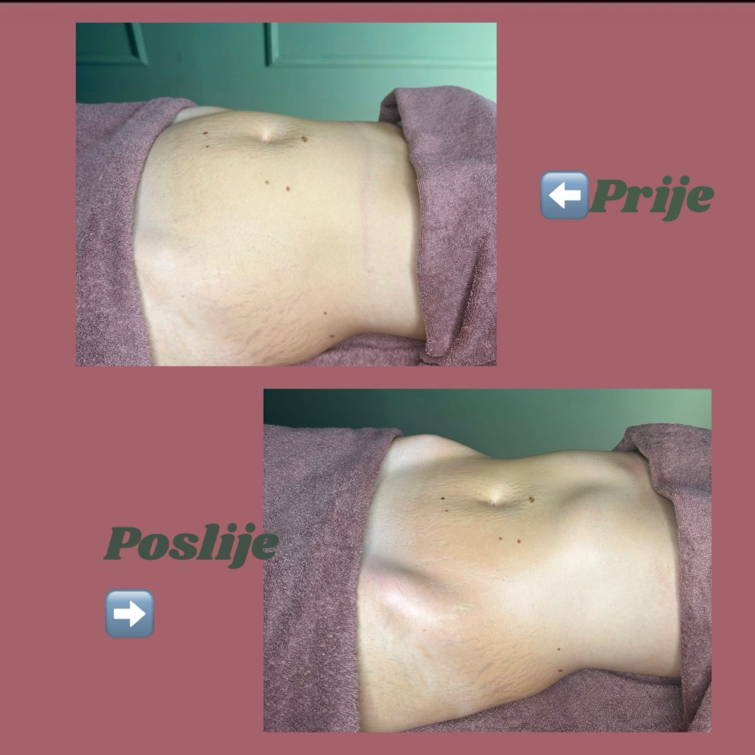 Shine #sarajevo Tretmani tijela Limfomodelovanje - cijelo tijelo