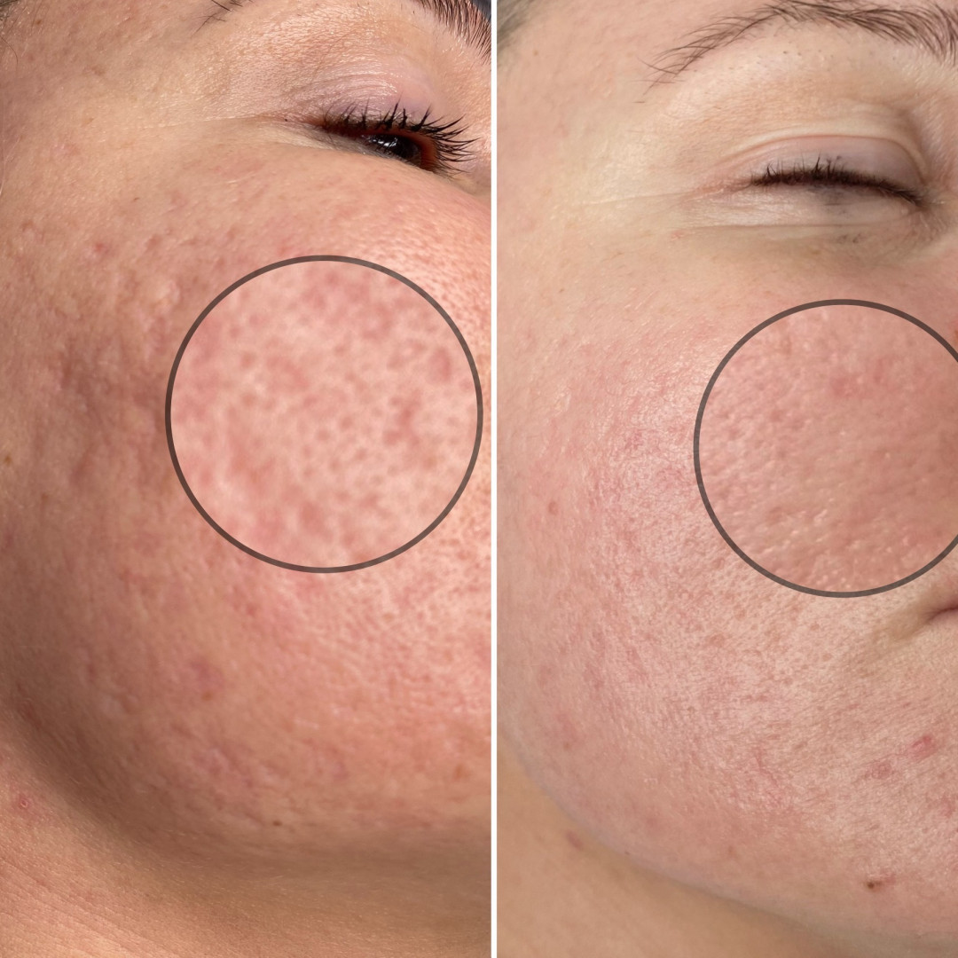 Paket tretmana za ožiljke od akni - Fabrika ljepote, Sarajevo Tretmani tijela Tijelo Tretmani tijela, Sarajevo, Istočno Sarajevo