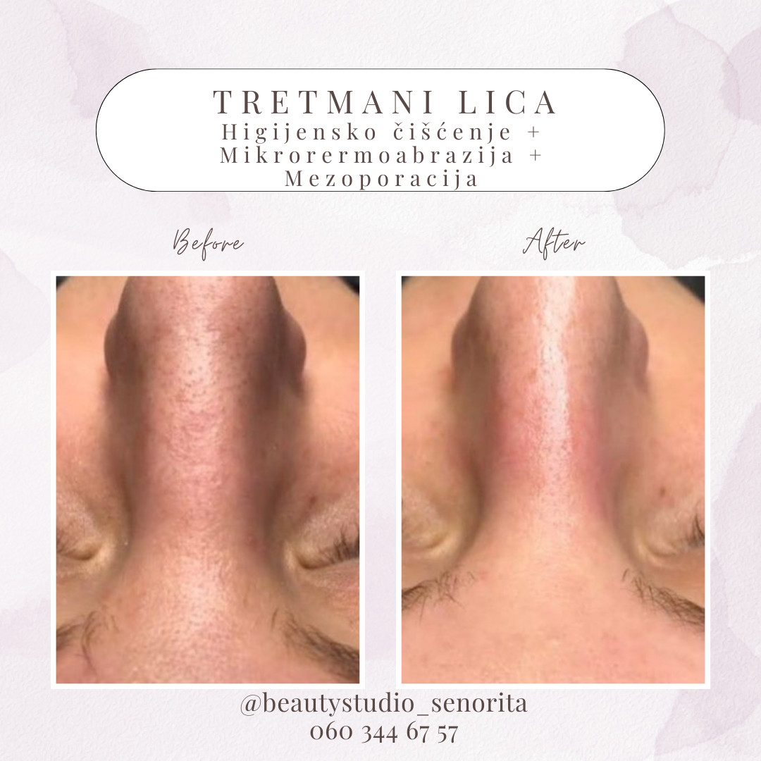 Beauty Studio Señorita #sarajevo Tretman lica Higijenski tretman čišćenja lica + Mikrodermoabrazija + Hranjenje lica - Mezoporacijom
