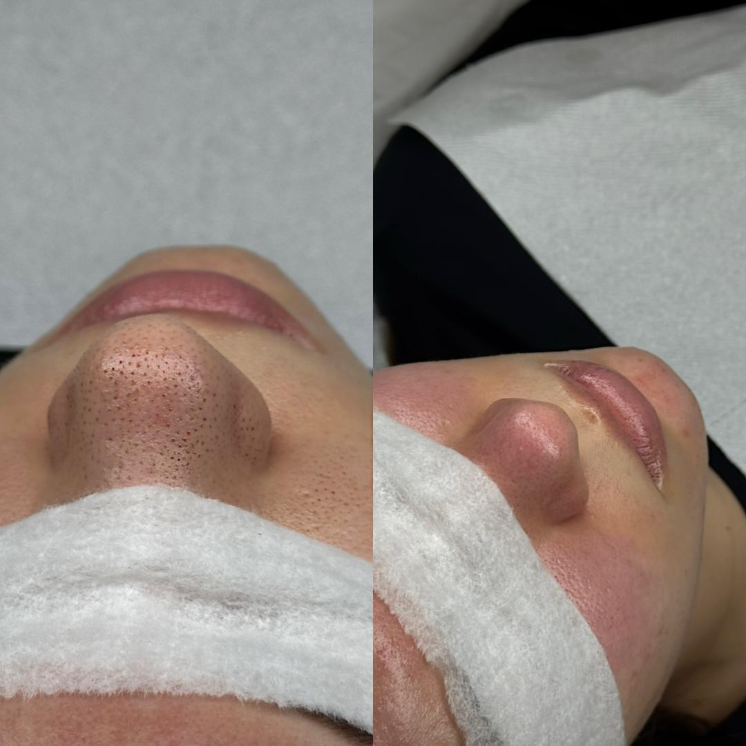 Hanas Skin Centar #banjaluka Air brush potamnjivanje kože Klasično higijensko čišćenje lica