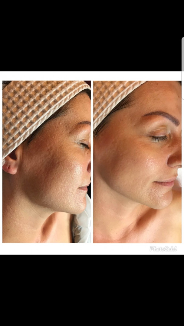 Vedrana #sarajevo Tretman lica