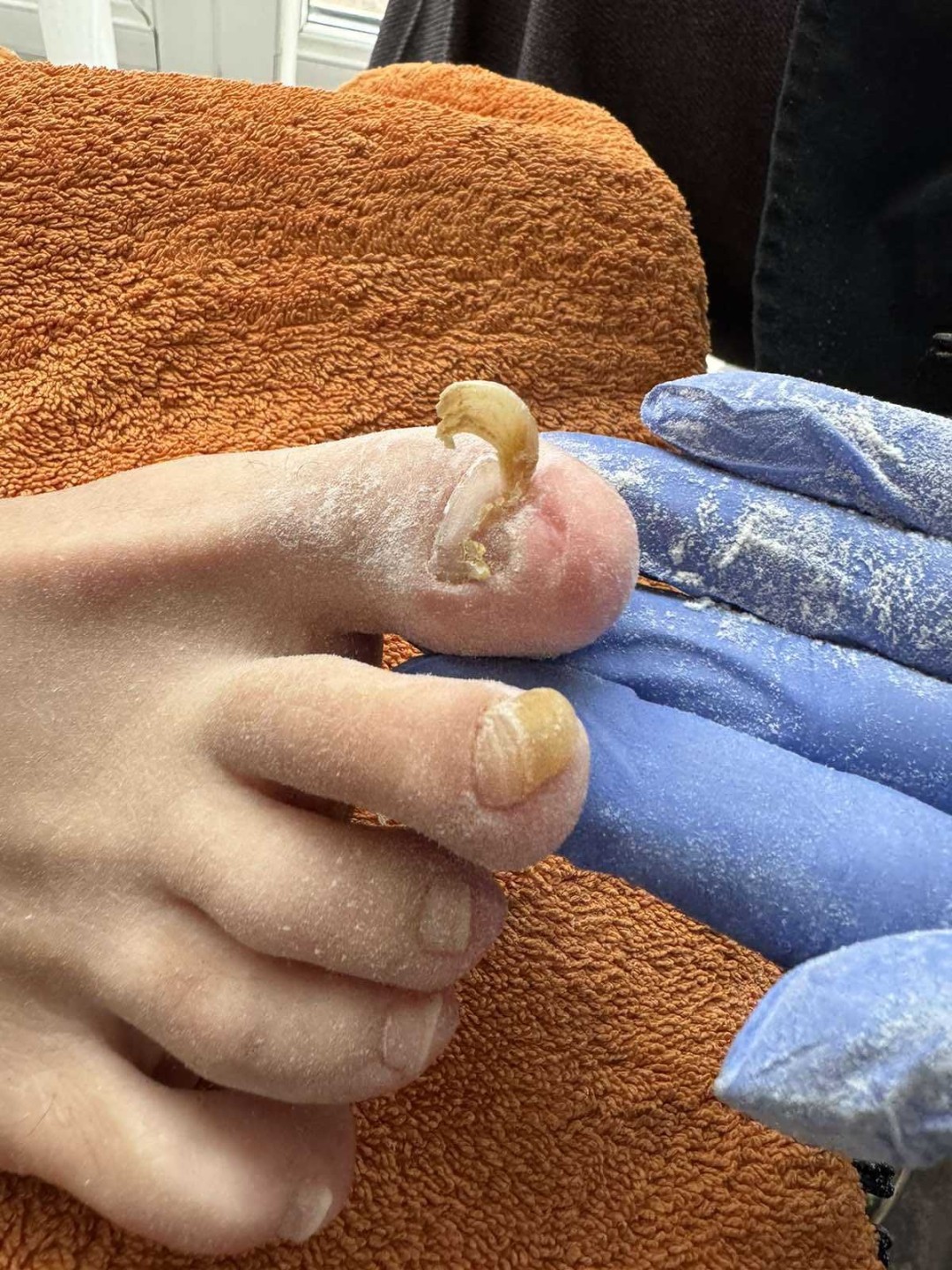 Sanpatra #zenica Medicinski pedikir Liječenje gljivica