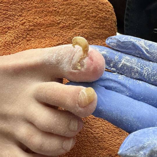 Sanpatra #zenica Medicinski pedikir Liječenje gljivica Medicinski tretman lijecenja gljivica